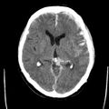 Cerebral hemorrhagic contusions (Radiopaedia 23145-23188 Axial non-contrast 19).jpg
