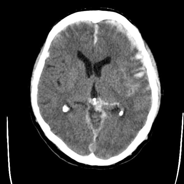 File:Cerebral hemorrhagic contusions (Radiopaedia 23145-23188 Axial non-contrast 19).jpg