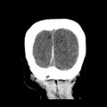 Cerebral hemorrhagic contusions (Radiopaedia 23145-23188 Coronal non-contrast 39).jpg
