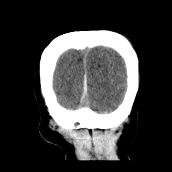 File:Cerebral hemorrhagic contusions (Radiopaedia 23145-23188 Coronal non-contrast 39).jpg
