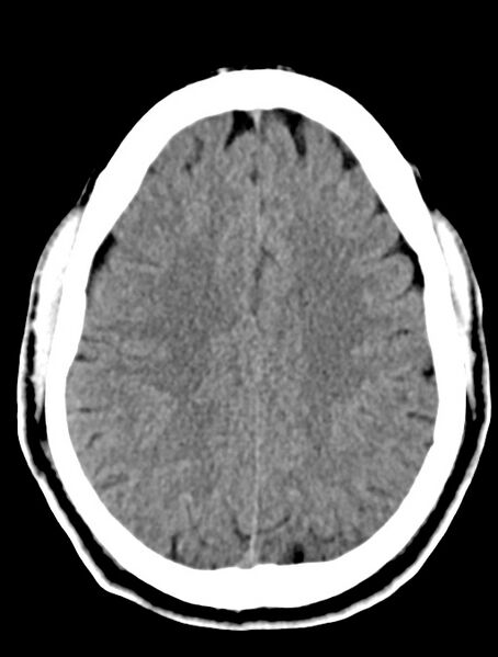 File:Cerebral venous angioma (Radiopaedia 69959-79977 Axial non-contrast 22).jpg