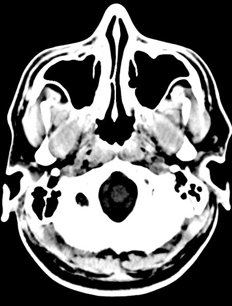 File:Cerebral venous angioma (Radiopaedia 69959-79977 Axial non-contrast 5).jpg