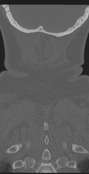 File:Cervical canal stenosis - OPLL and osteophytes (Radiopaedia 47329-51910 Coronal bone window 64).png