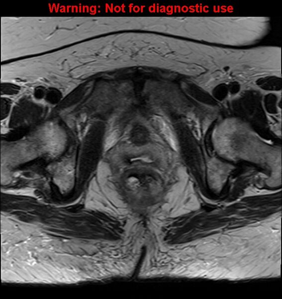 File:Cervical cancer (Radiopaedia 24151-24410 Axial T2 24).jpg