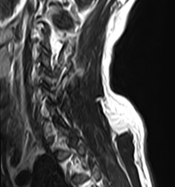 File:Cervical compressive myelopathy (Radiopaedia 71956-82411 C 3).jpg