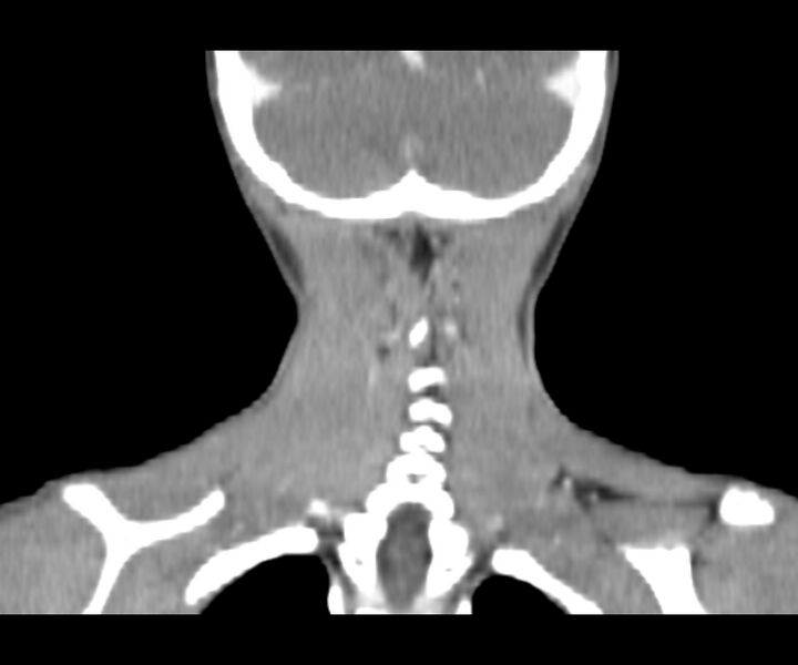File:Cervical cystic lymphangioma (Radiopaedia 63655-72332 Coronal + contrast 30).jpg