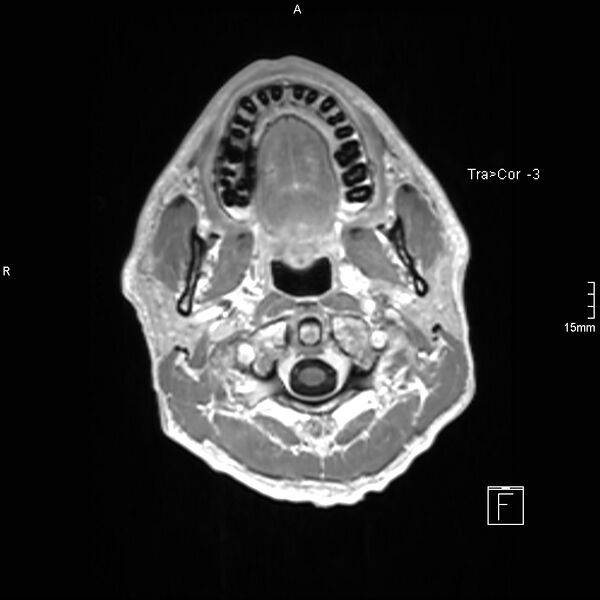 File:Cervical dural CSF leak on MRI and CT treated by blood patch (Radiopaedia 49748-54995 Axial T1 C+ 4).jpg