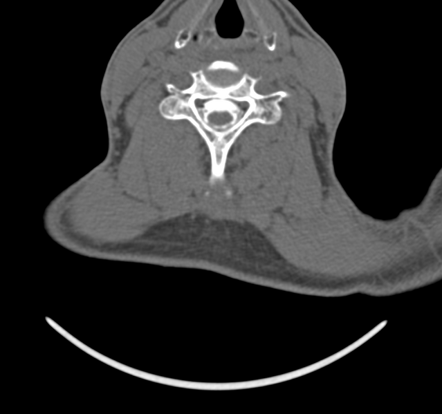 File:Cervical dural CSF leak on MRI and CT treated by blood patch (Radiopaedia 49748-54996 B 33).png
