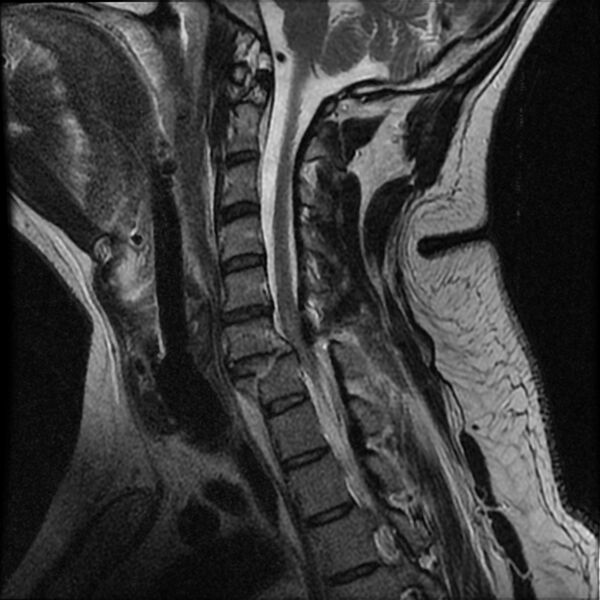 File:Cervical fracture and dislocation with locked facet (Radiopaedia 31837-32781 Sagittal T2 6).jpg
