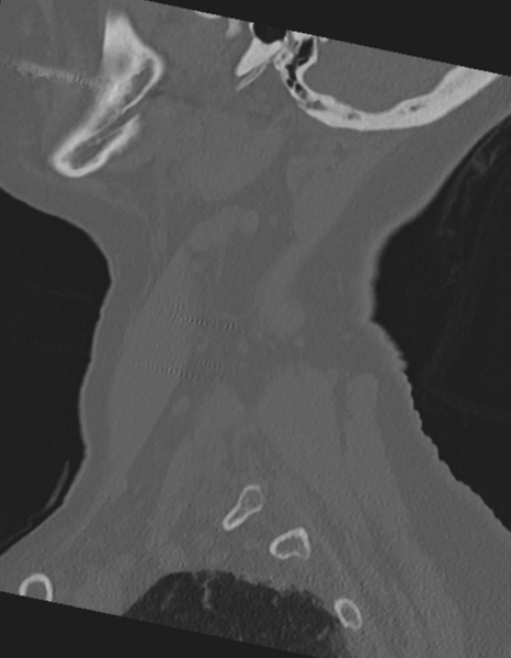 File:Cervical spine ACDF loosening (Radiopaedia 48998-54071 Sagittal bone window 16).png
