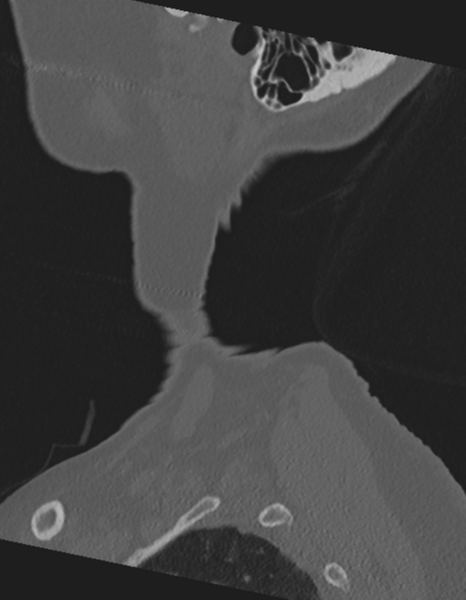 File:Cervical spine ACDF loosening (Radiopaedia 48998-54071 Sagittal bone window 6).png
