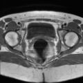 Cesarian section scar endometriosis (Radiopaedia 66520-75799 Axial T1 18).jpg