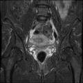 Cesarian section scar endometriosis (Radiopaedia 66520-75799 Coronal STIR 18).jpg