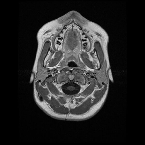 File:Chiasmatic-hypothalamic juvenile pilocytic astrocytoma (Radiopaedia 78533-91236 Axial T1 C+ 2).jpg