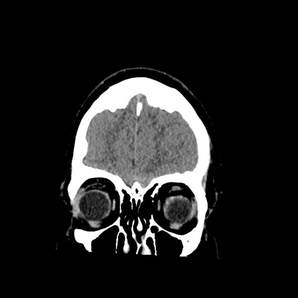File:Chiasmatic-hypothalamic juvenile pilocytic astrocytoma (Radiopaedia 78533-91237 Coronal non-contrast 14).jpg