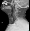 Chicken bone (fibula) perforation of the pharynx (Radiopaedia 21332-21260 Lateral 1).jpg