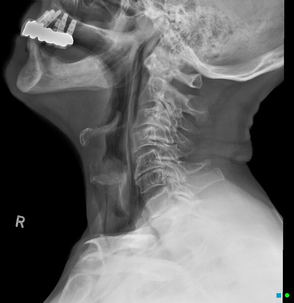 File:Chicken bone (fibula) perforation of the pharynx (Radiopaedia 21332-21260 Lateral 1).jpg