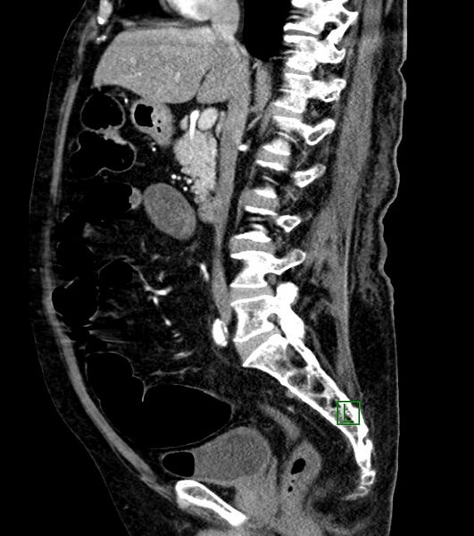 File:Cholangiocarcinoma with cerebral metastases (Radiopaedia 83519-98629 F 68).jpg