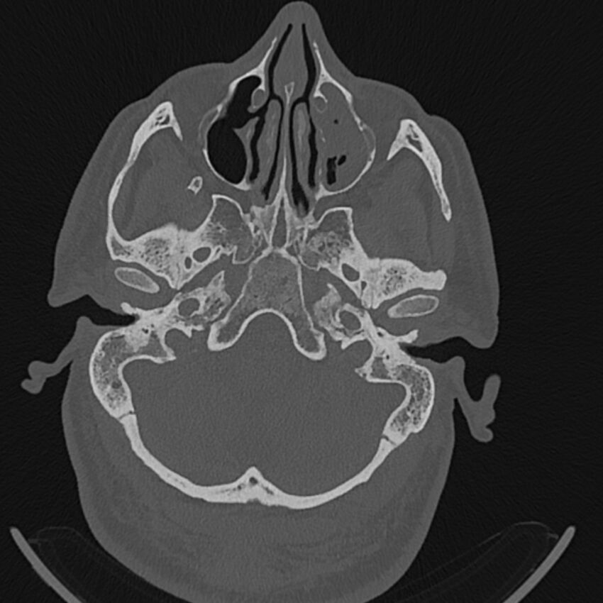 Cholesteatoma (Radiopaedia 68176-77673 Axial bone window 18).jpg