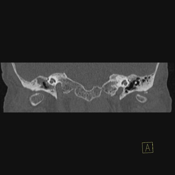 File:Cholesteatomatous chronic otitis (Radiopaedia 14993-14911 Coronal bone window 15).JPEG