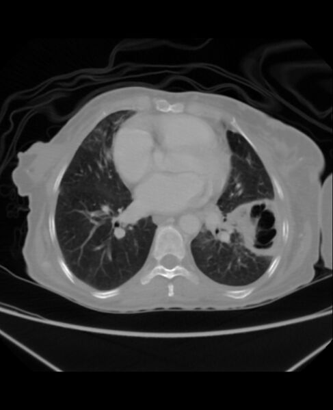 File:Chondrosarcoma (Radiopaedia 79427-92535 Axial lung window 32).jpg