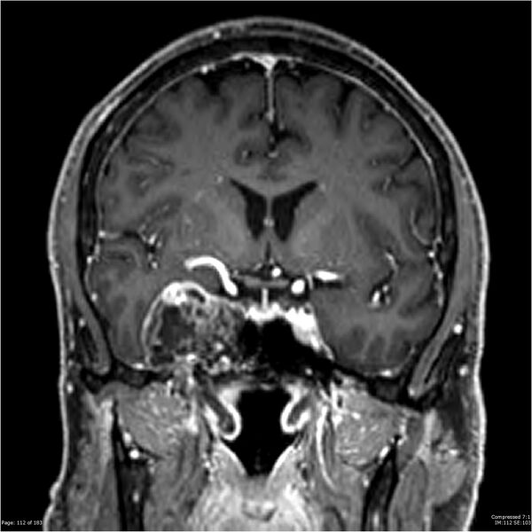 File:Chondrosarcoma of skull base- grade II (Radiopaedia 40948-43654 Coronal T1 C+ 23).jpg