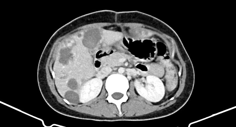File:Choriocarcinoma liver metastases (Radiopaedia 74768-85766 A 87).jpg