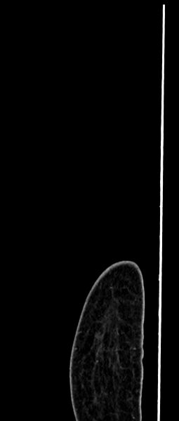 File:Choriocarcinoma liver metastases (Radiopaedia 74768-85766 C 18).jpg