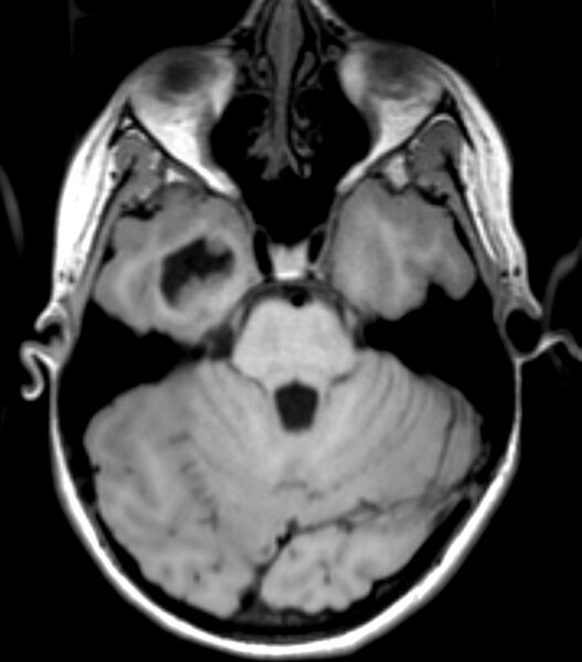 File:Choroid plexus carcinoma (Radiopaedia 91013-108553 Axial T1 60).jpg