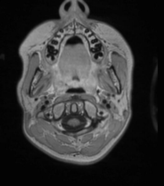 File:Choroid plexus carcinoma (Radiopaedia 91013-108553 Axial T1 C+ 57).jpg