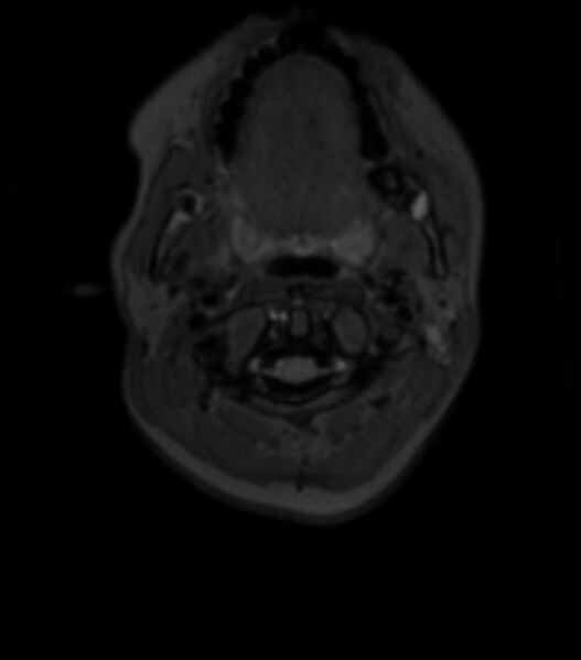 File:Choroid plexus carcinoma (Radiopaedia 91013-108553 Axial T2 fat sat 10).jpg