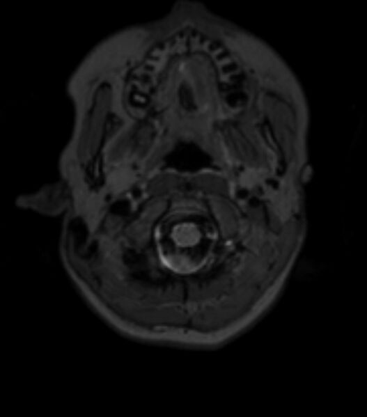 File:Choroid plexus carcinoma (Radiopaedia 91013-108553 Axial T2 fat sat 25).jpg