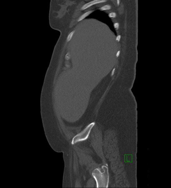 File:Chromophobe renal cell carcinoma (Radiopaedia 84239-99519 Sagittal bone window 93).jpg