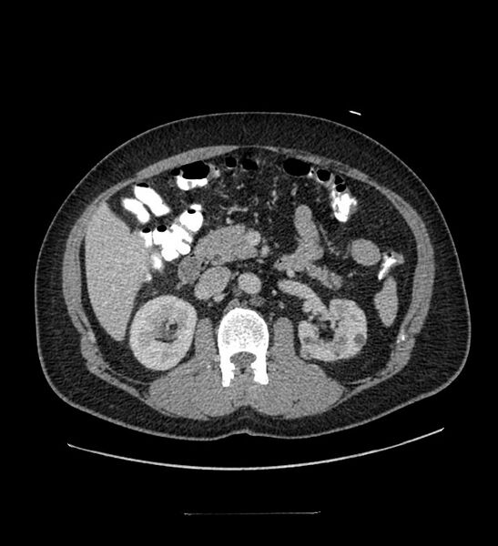 File:Chromophobe renal cell carcinoma (Radiopaedia 84337-99644 C 52).jpg