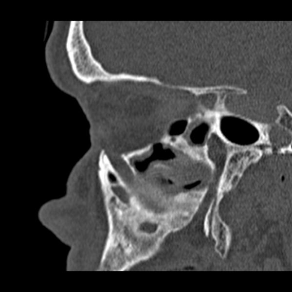 File:Chronic maxillary sinusitis (Radiopaedia 27879-28116 Sagittal bone window 38).jpg