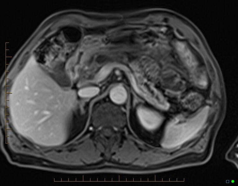 File:Chronic pancreatitis (Radiopaedia 17014-16716 Axial T1 C+ fat sat 24).jpg