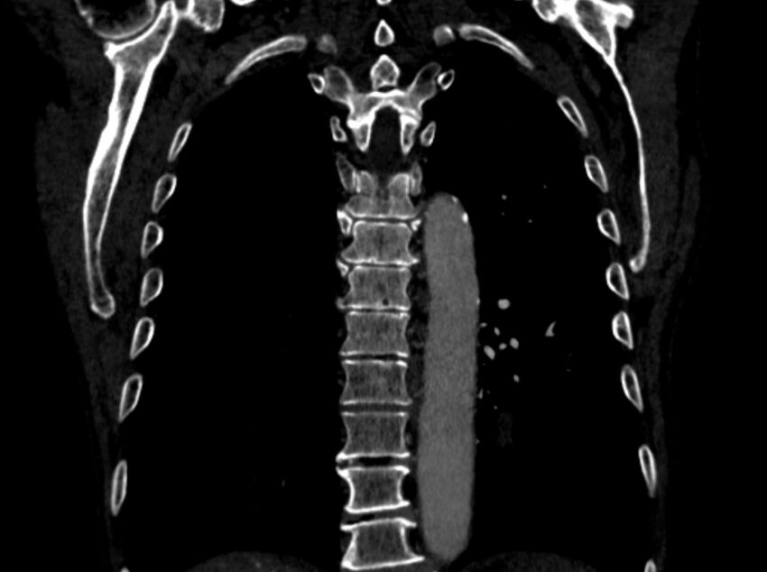 Chronic pulmonary embolism (Radiopaedia 91241-108843 A 84).jpg