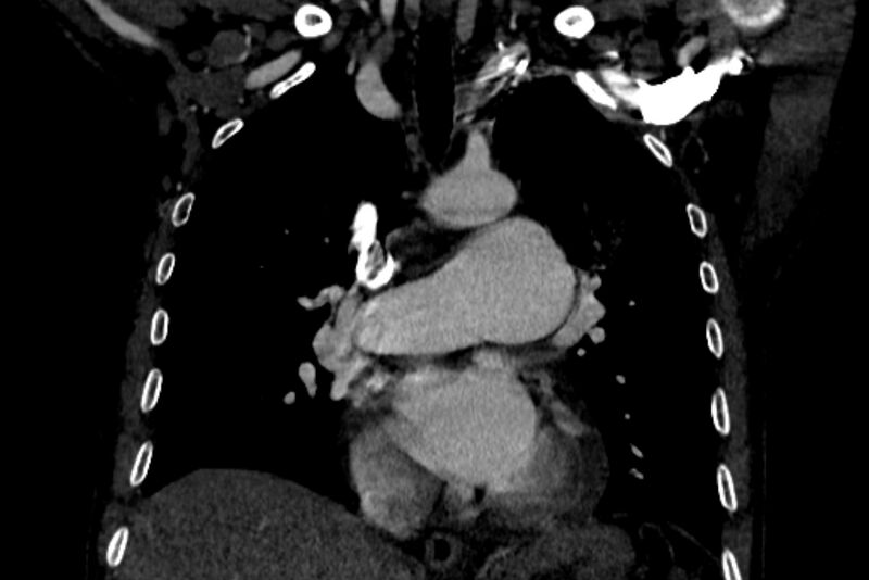 File:Chronic pulmonary embolism with bubbly consolidation (Radiopaedia 91248-108850 B 69).jpg