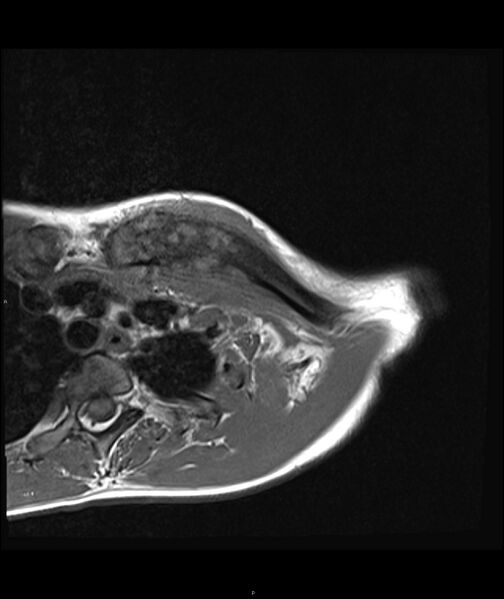 File:Chronic reactive multifocal osteomyelitis (CRMO) - clavicle (Radiopaedia 56406-63071 Axial T1 8).jpg