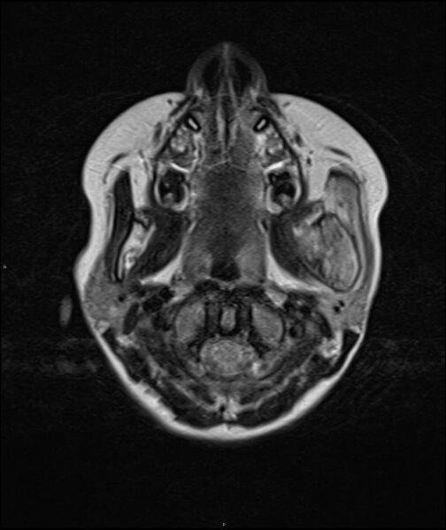 File:Chronic reactive multifocal osteomyelitis (CRMO) - mandible (Radiopaedia 56405-63069 Axial T2 15).jpg