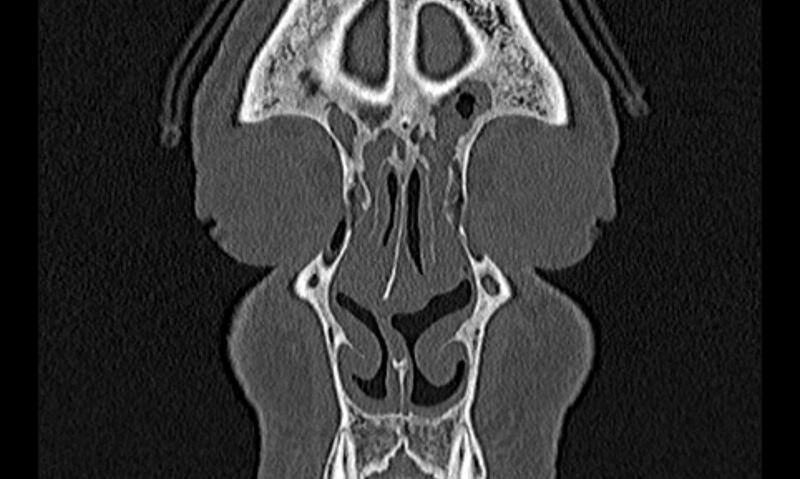 File:Chronic rhinosinusitis (Radiopaedia 65079-74075 Coronal bone window 11).jpg