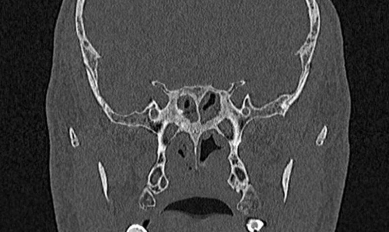 File:Chronic rhinosinusitis (Radiopaedia 65079-74075 Coronal bone window 64).jpg