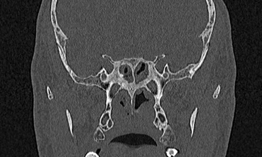 Chronic rhinosinusitis (Radiopaedia 65079-74075 Coronal bone window 64).jpg