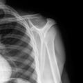 Clavicle fracture (Radiopaedia 8166-9014 Lateral 1).jpg