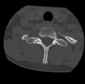 Clay-shoveler fracture (Radiopaedia 22568-22590 Axial bone window 65).jpg