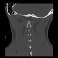 Clay-shoveler fracture (Radiopaedia 22568-22590 Coronal bone window 35).jpg