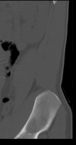 File:Clear cell meningoma - lumbar spine (Radiopaedia 60116-67691 Sagittal bone window 3).png