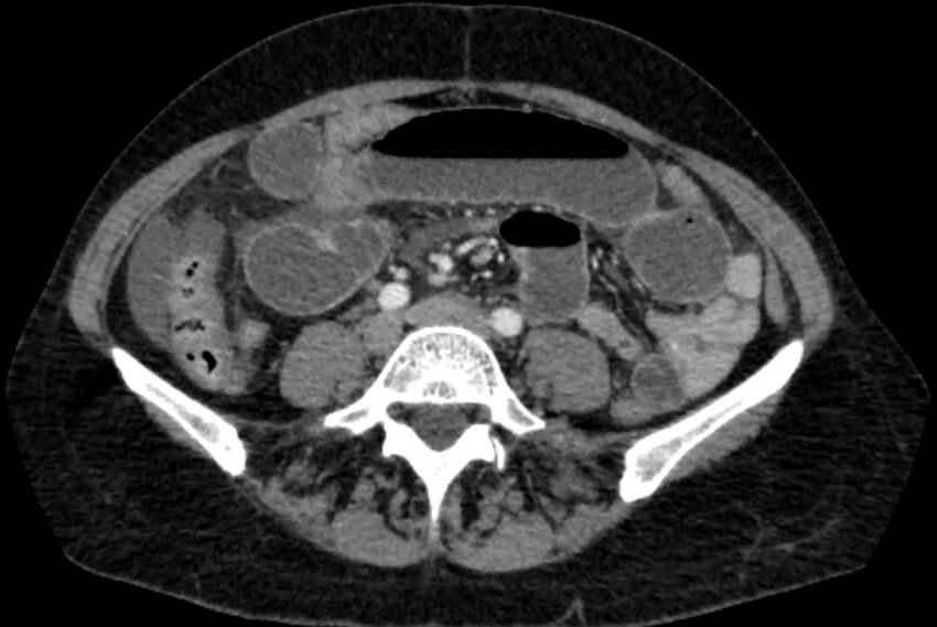 Closed loop small bowel obstruction (Radiopaedia 71211-81508 A 83).jpg