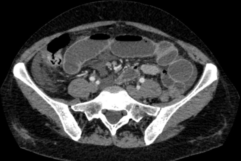 File:Closed loop small bowel obstruction (Radiopaedia 71211-81508 A 98).jpg