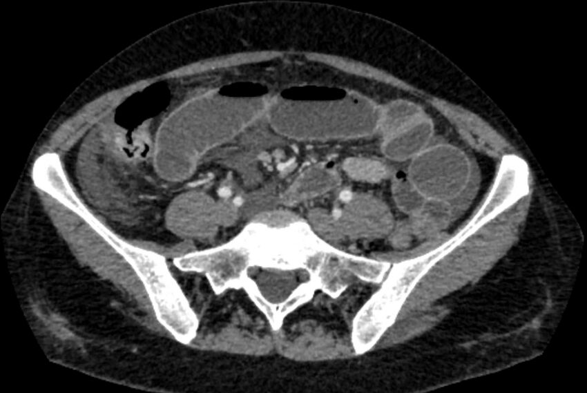 Closed loop small bowel obstruction (Radiopaedia 71211-81508 A 98).jpg